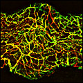 Local aneurism in mesenteric artery.